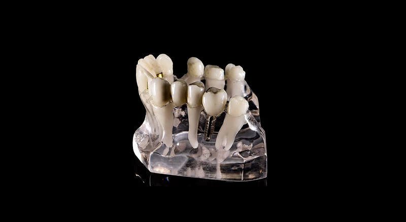 Dental Implants
